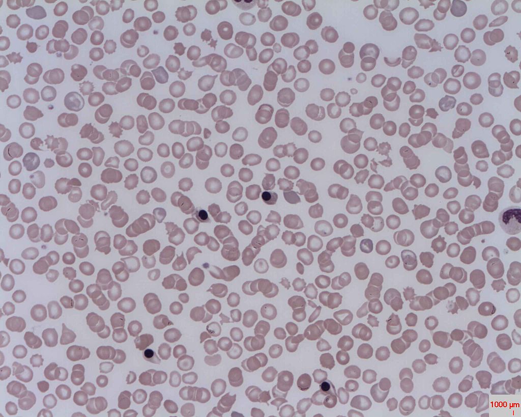 Fig.1 Human peripheral blood smear. (From Wikipedia https://en.wikipedia.org/wiki/Nucleated_red_blood_cell#/media/File:Nucleated_red_cells.jpg)